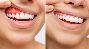 Gum Health Treatment